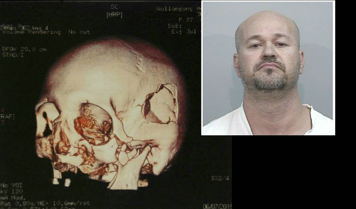 A CT scan shows the victim's head injuries following the violent assault. Doctors said the woman's skull was 'caved in' and she had a smashed jaw and cheek bone. Picture: Supplied. Inset: Christopher Coombs