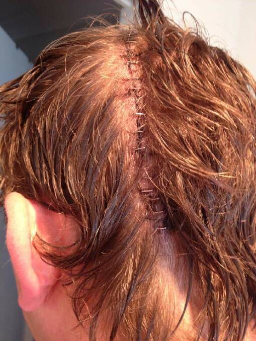 Surgeons cut a 30 centimetre incision from the bottom of Josh Drover's head to the top. Photo contributed. 

