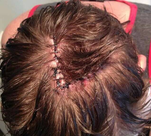 Josh had a four centimetre incision made around the melanoma on the top of his head. Photo contributed.