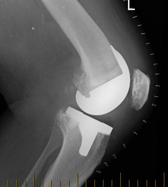 Left knee x-ray.