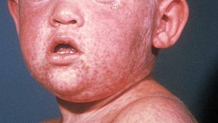 The measles rash on the face of a child. Photo: Centres for Disease Control and Prevention