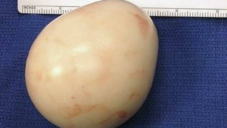 The lump, which resembles a boiled egg, found inside the patient's stomach. Photo: The New England Journal of Medicine
