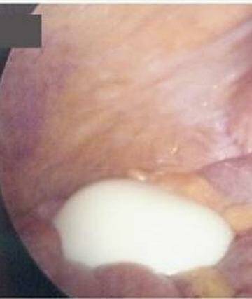 The lump, which resembles a boiled egg, inside the patient's stomach. Photo: The New England Journal of Medicine
