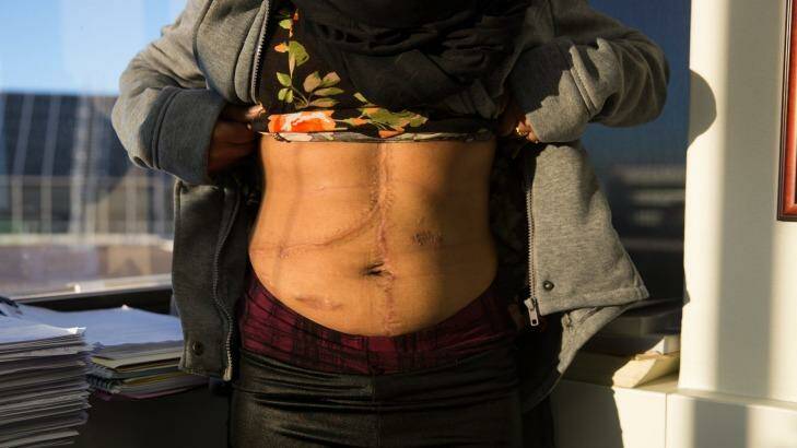 Rajvir Kaur's scars are from a liver transplant and bowel surgery that she had to have after eating the mushrooms. Photo: Edwina Pickles