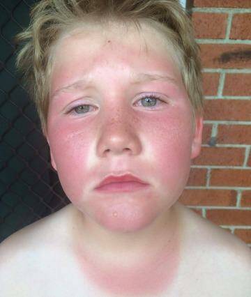 Damien McCaull got sunburnt on Australia Day.  Photo: Supplied