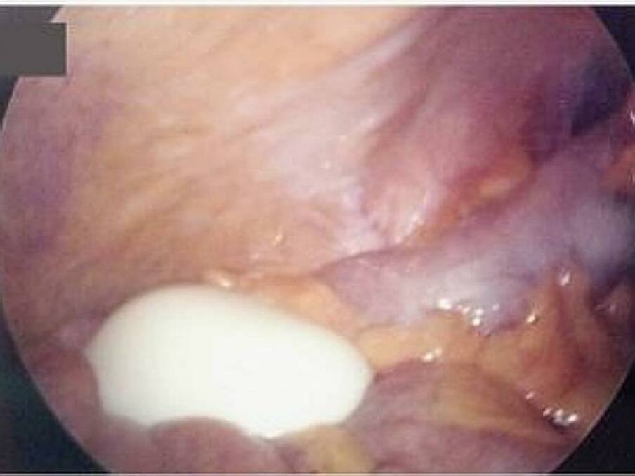 The lump, which resembles a boiled egg, inside the patient's stomach. Photo: The New England Journal of Medicine