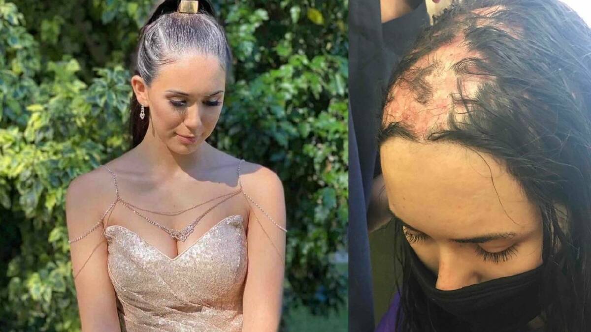 Eve, 19, who grew up in Sanctuary Point and moved to Wollongong to pursue a psychology degree this year, has shared her experience with alopecia, psoriasis and other conditions. Pictures: supplied.