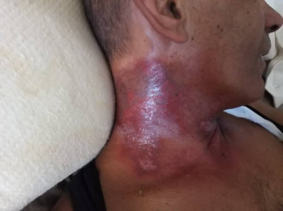 The burns on Nathan Aldridge's neck caused by the radiation treatment.