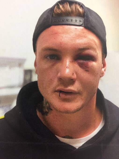 William Dendy's injuries, photo taken by NSW Police. 