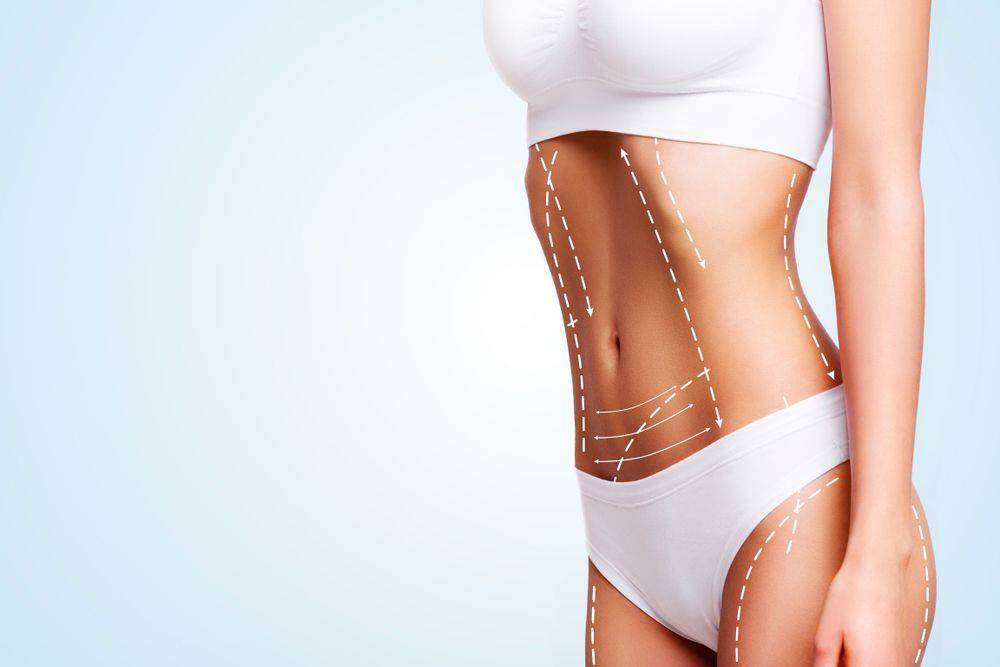 Benefits of liposuction when having trouble losing weight