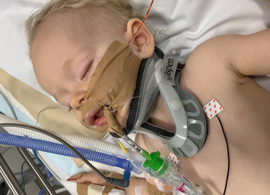 Young Oscar Karlson in Westmead Hospital after suffering the electric shock. Photo: Supplied/Claire Karlson