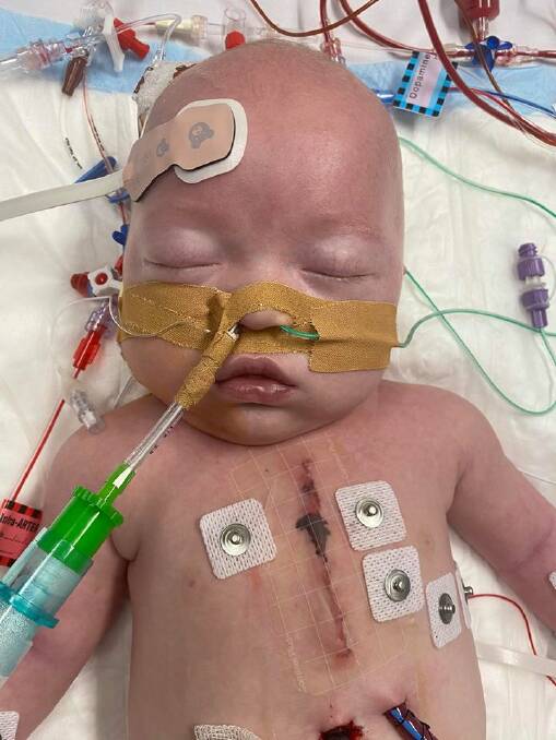 TOUGH START: Mason had his first open heart surgery at five weeks old.