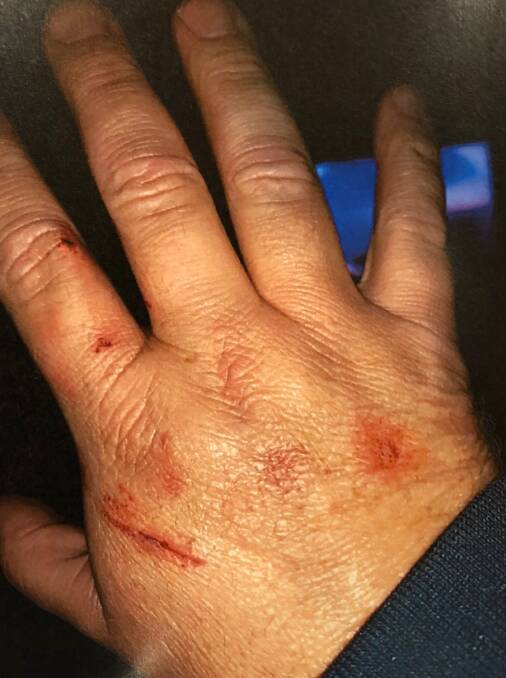 The police officer's injured hand after Jesse Craig allegedly rammed his patrol car at Albion Park Rail on Tuesday morning. Picture: Supplied